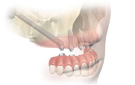 Zygomatic Implants Montreal Zygomatic Dental Implants Near Me