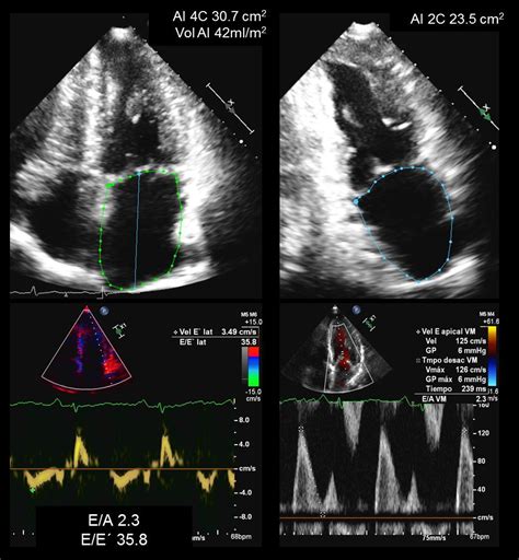 Doppler Pulsado Ecocardiografia