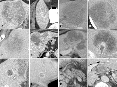 Imaging Features Of Intrahepatic Cholangiocarcinoma Visually Assessed