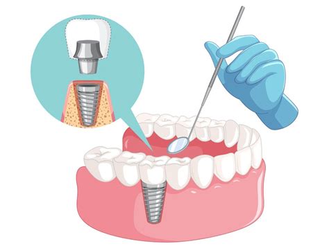 Dental Implant Process Step by Step: A Comprehensive Guide