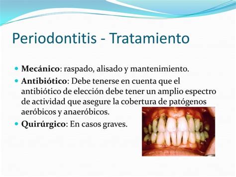 Enfermedades Bucales Ppt