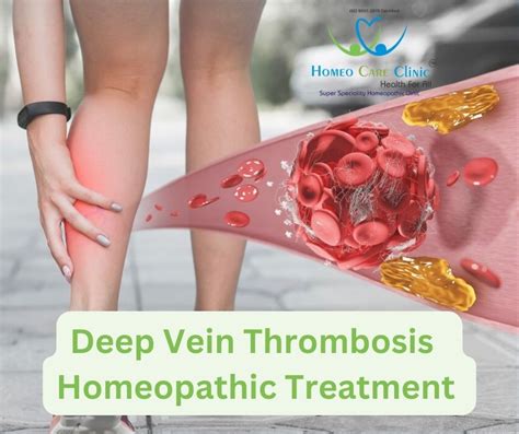 Deep Vein Thrombosis Dvt Causes Symptoms And Homeopathy Medicine