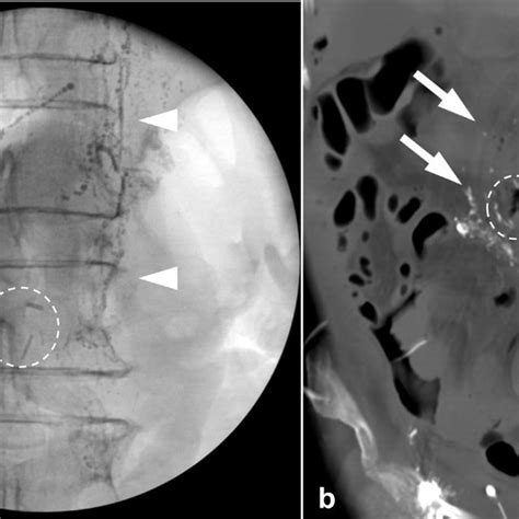 Fluoroscopic Spot Radiograph A And Ct Multiplanar Reformatted Image