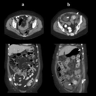 Progression Of Stercoral Colitis To Perforation In 66 Year Old Female