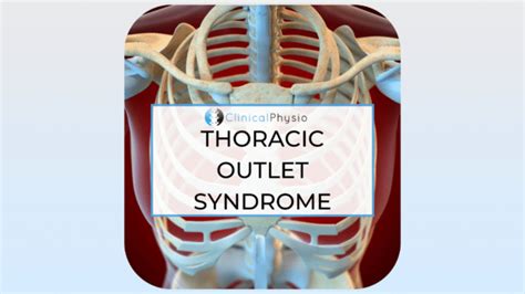 Thoracic Outlet Syndrome Clinical Physio Membership