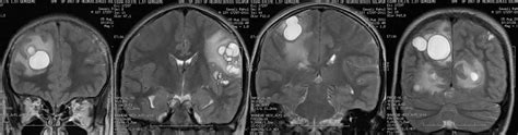 Dr Balaji Anvekar Frcr Multiple Ring Enhancing Lesions In Brain