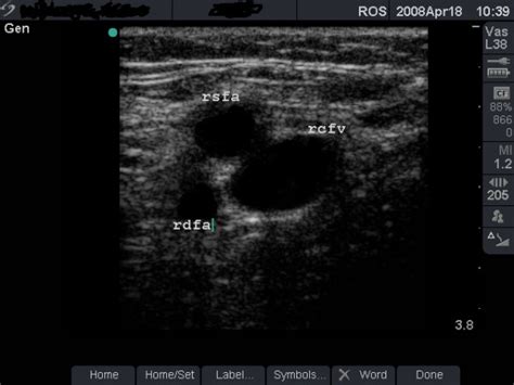 Femoral Artery Anterior To Femoral Vein B Mode Image Taken 3 Cm Below