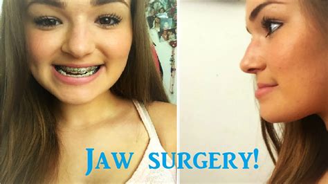 Pre Op Double Jaw Surgery 2015 Youtube