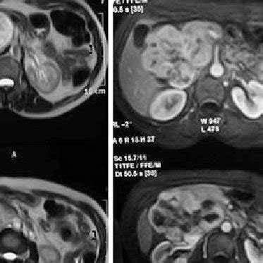 Magnetic Resonance Imaging Abdomen Showing A Large Retroperitoneal Mass