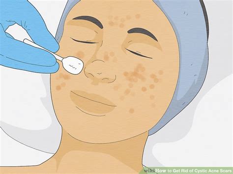 4 Ways to Get Rid of Cystic Acne Scars - wikiHow