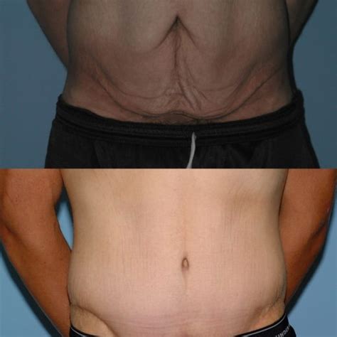 Tummy Tuck Gallery Dr Paul Vanek Md