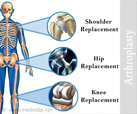 Arthroplasty Course 2024 - Gilly Barbara-Anne