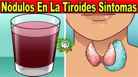 NÃ³dulos En La Tiroides SÃntomas y Tratamiento Natural Prueba Este