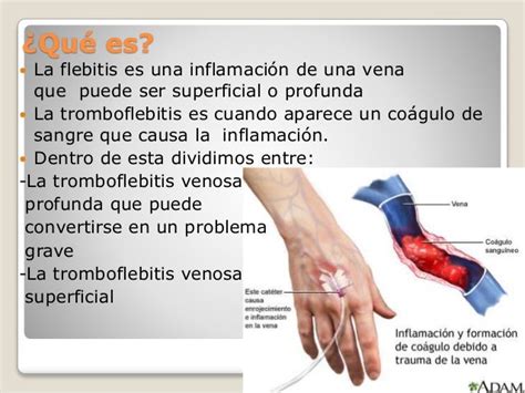 Aparición Y Tratamiento De Una Flebitis