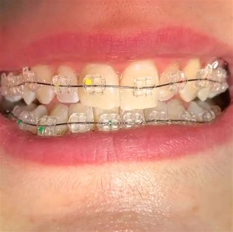 Precio Brackets Met Licos Zafiro Y Transparentes Denty Dent