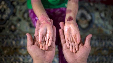 Epidermolysis Bullosa Symptoms Causes And Treatments