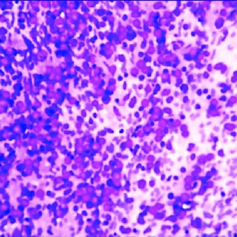 Photomicrograph Showing Poorly Differentiated Synovial Cell Sarcoma