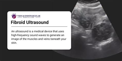 Fibroid Ultrasound - Vein & Endovascular Medical Care