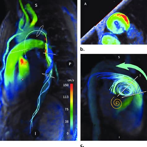 Cardiac D Flow Mri Of Aortic Coarctation In A Year Old Man With