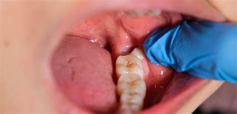 10 Causes Of Black Spots On Tongue When Should You Worry