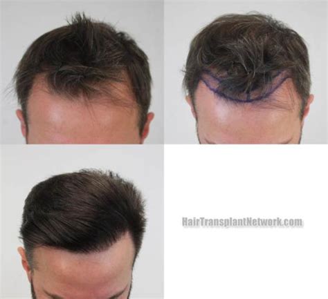 Dr H Rahal Hair Restoration Surgery Before And After Result