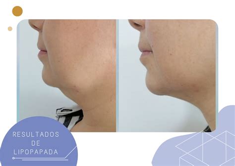 Lipopapada con enzimas vs lipopapada quirúrgica Viena