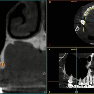 Cone Beam Computed Tomography Image Five Months After The Length