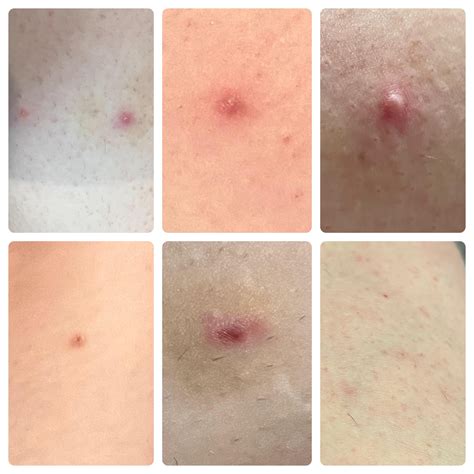 Reoccurring-Cyst? Boil? Infected ingrown hair? : r/DiagnoseMe