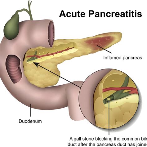 Pancreatitis: Symptoms, Causes, Diagnosis - UAmedTOURS