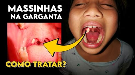 Massinhas fedidas na garganta Como se livrar Tratamento de Cáseo