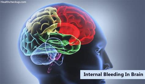 Internal Bleeding in Brain Symptoms, Causes, Diagnosis, Treatment