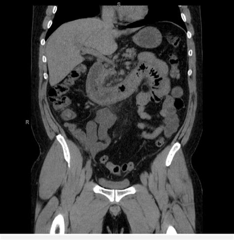 Ct Scan Abdomen Pelvis Anatomy