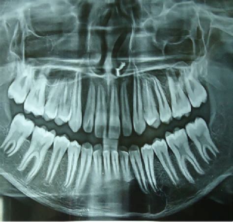 Pre Operative Panoramic View Showing A Well Defined Unilocular