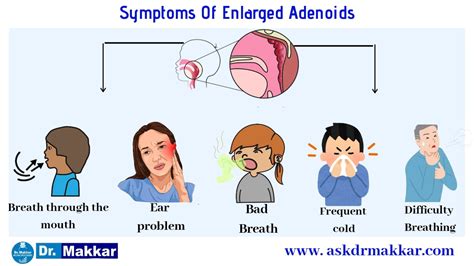 Adenoid || Adenoid facies || Nasal Polyp || Causes || Homeopathic treatment || Best Medicine