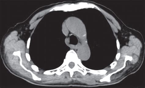 PET CT Of Esophageal Cancer Its Role In Clinical Management