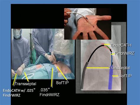 Percutaneous Left Atrial Appendage Ligation With Lariat