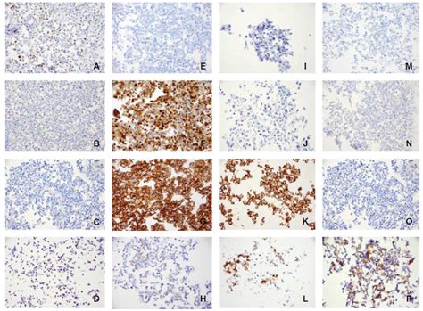 The Expression Patterns Of Er Pr Her2 Ck56 Egfr Ki 67 And Ar By