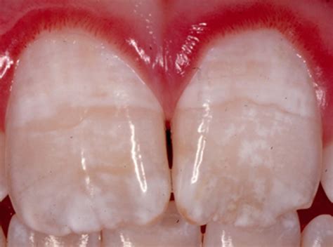 Dental fluorosis causes, prevention, symptoms & dental fluorosis treatment