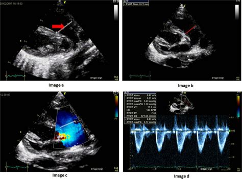 Assessment Of Right Ventricular Output Rvo On Echocardiography Image Download Scientific