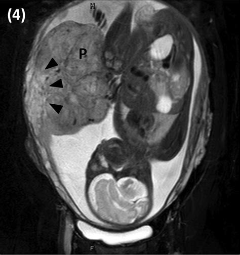 Placenta Increta After High Intensity Focused Ultrasound For The