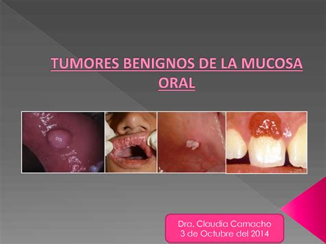 Solution Tumores Benignos De La Mucosa Oral Studypool