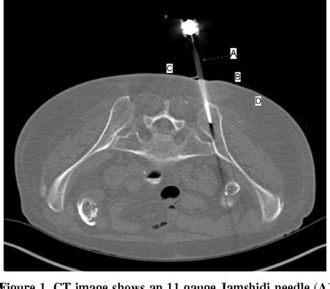 Figure 1 From Ct Guided Bone Marrow Aspiration And Core Biopsy