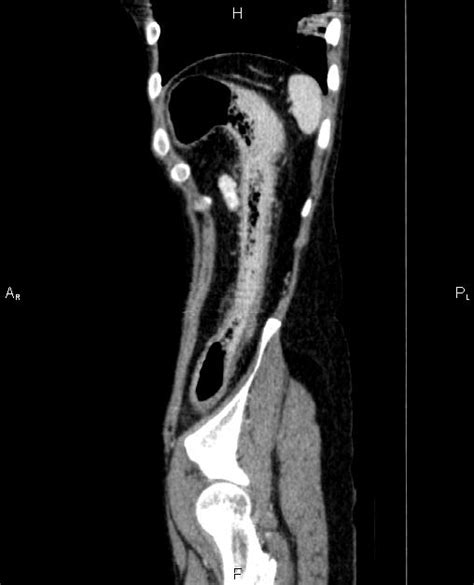 Ulcerative Colitis Image Radiopaedia Org