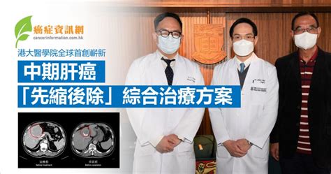 【癌症研究】港大醫學院全球首創嶄新中期肝癌「先縮後除」綜合治療方案 癌症資訊網