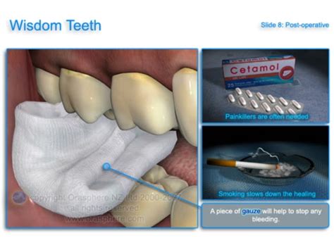 How Long Until Stitches Dissolve From Wisdom Teeth Teethwalls