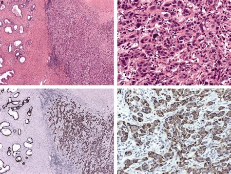 Urothelial Carcinoma Invading Into Prostatic Stroma Pt4a Urothelial Download Scientific