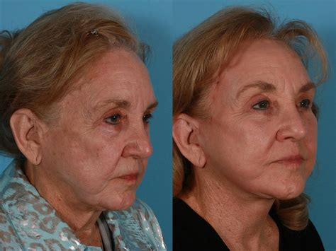 Patient 388792 Eyelid Surgery Blepharoplasty Before And After Photos Buckingham Center For