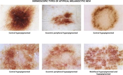 Compound Nevus With Mild Atypia