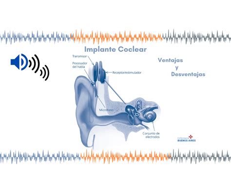 Implante Coclear Ventajas Y Desventajas 2024