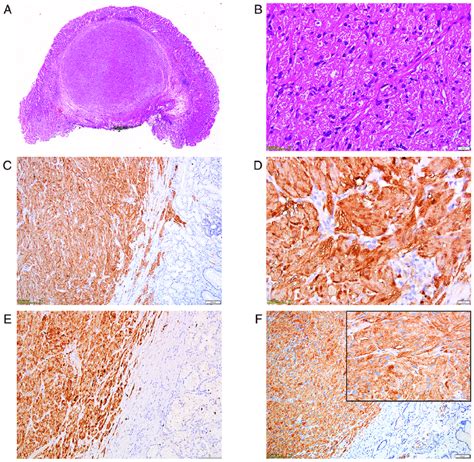 A Low Power View Of The Granular Cell Tumor Arising In The Submucosa